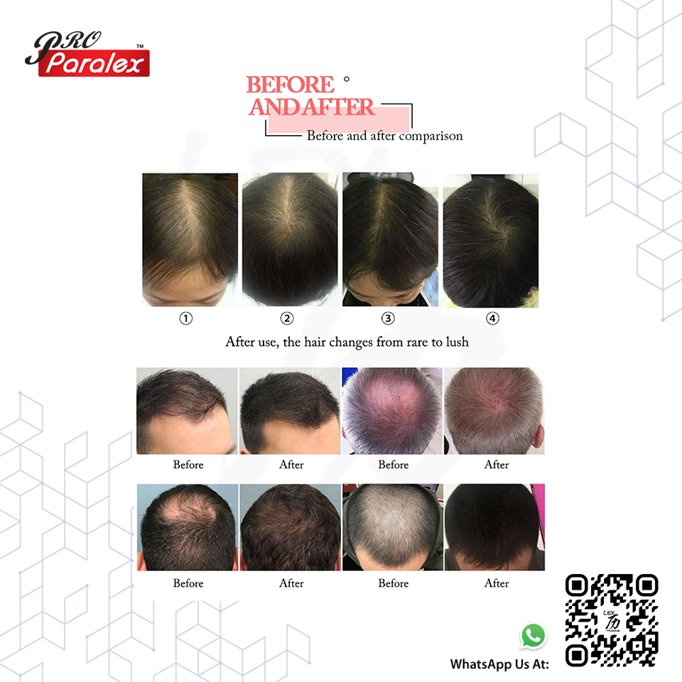 LEX12HG - Diode Laser Hair Growth Machine - 7